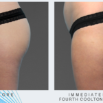 woman's thighs before and after CoolTone treatment showing improved muscle tone