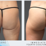 woman's buttocks before and after CoolTone treatment showing improved muscle tone