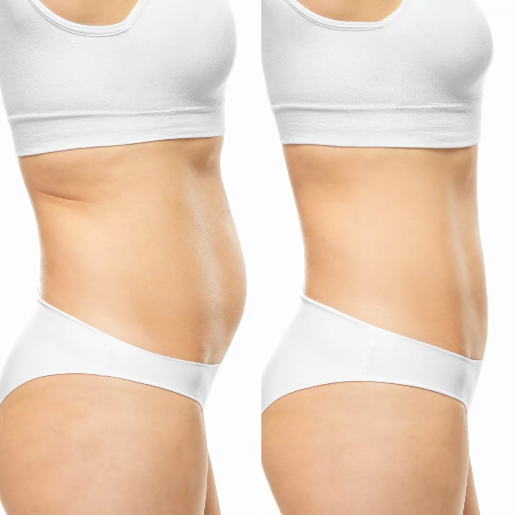 before and after cooltone to tone, firm and strengthen muscles