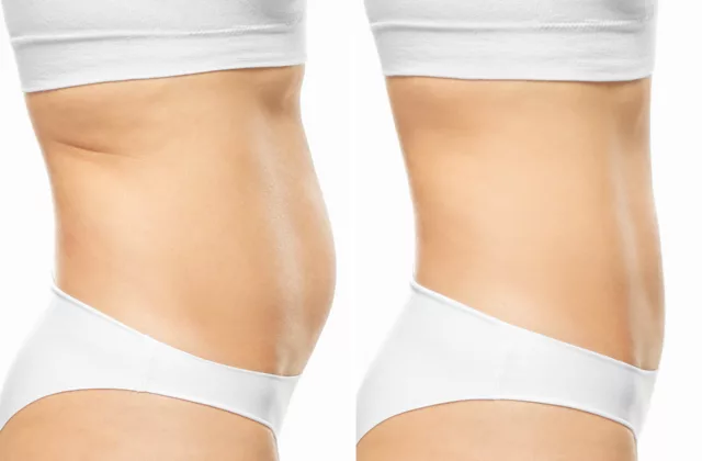 before and after cooltone to tone, firm and strengthen muscles
