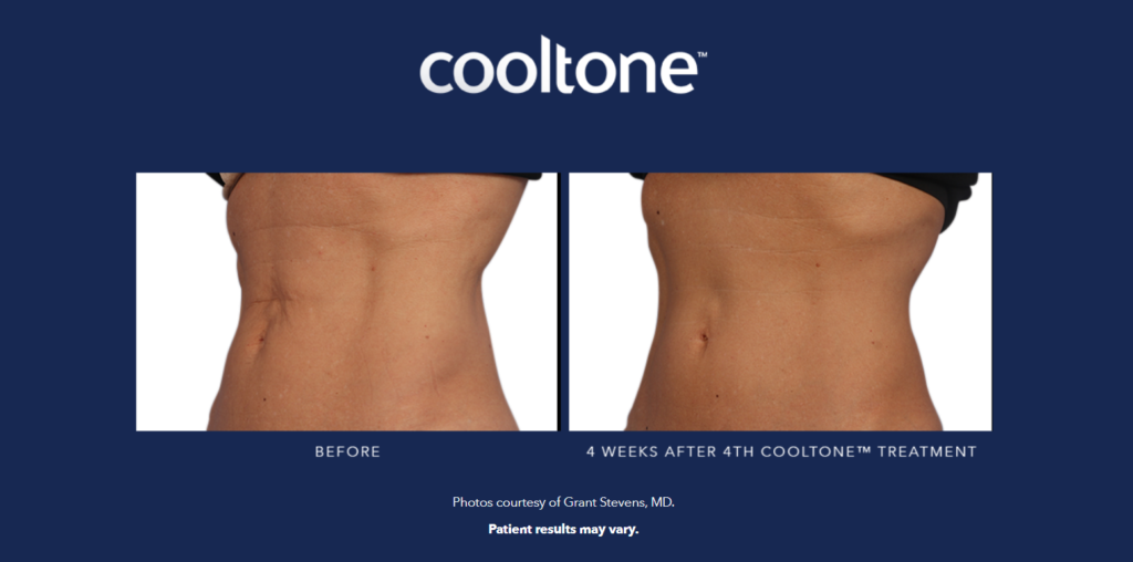 before and after cooltone