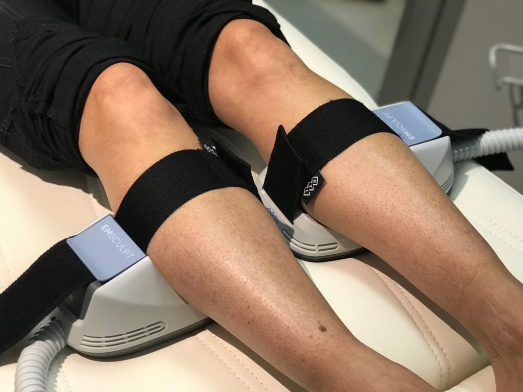 woman receiving emsculpt procedure on her legs