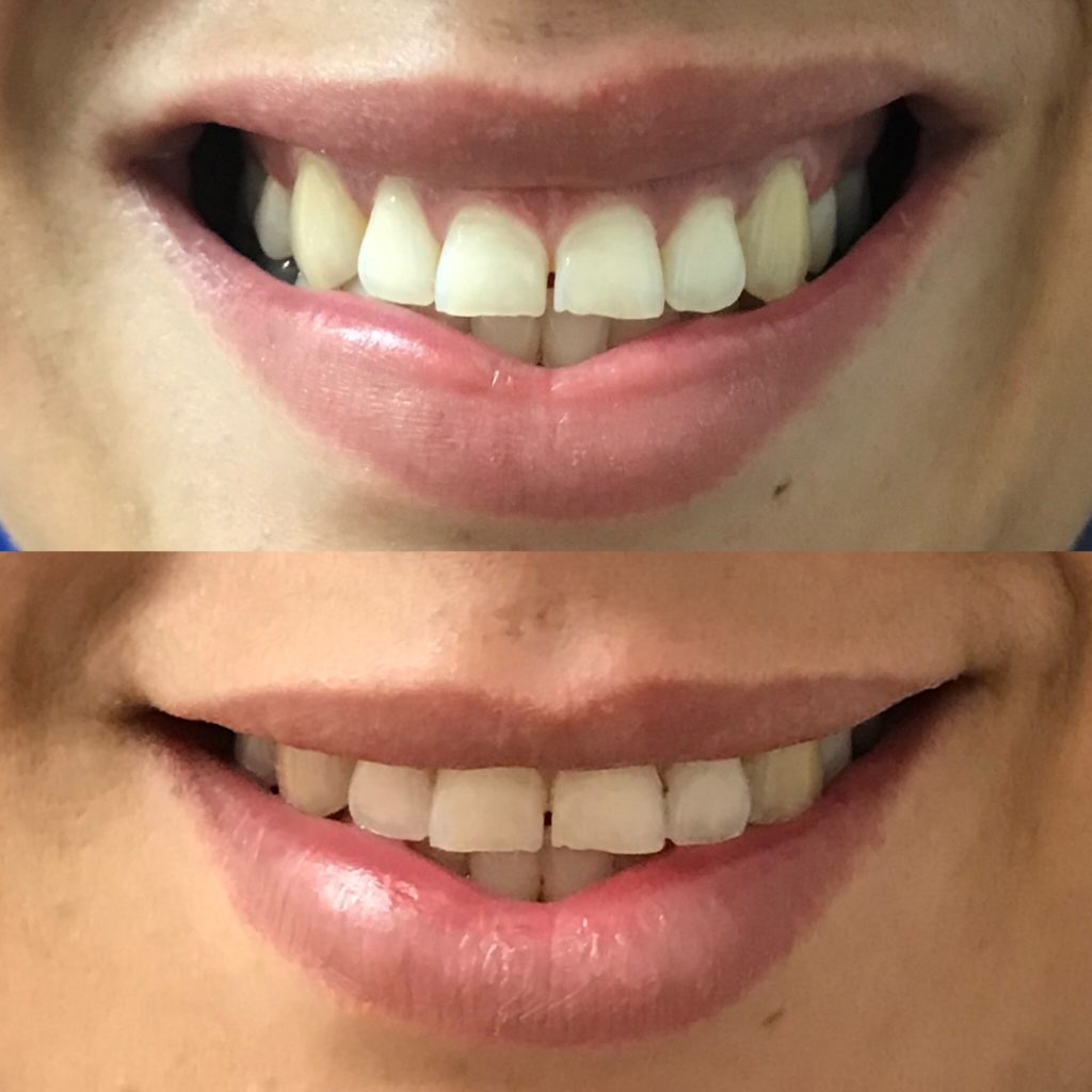 woman's gummy smile before and after botox