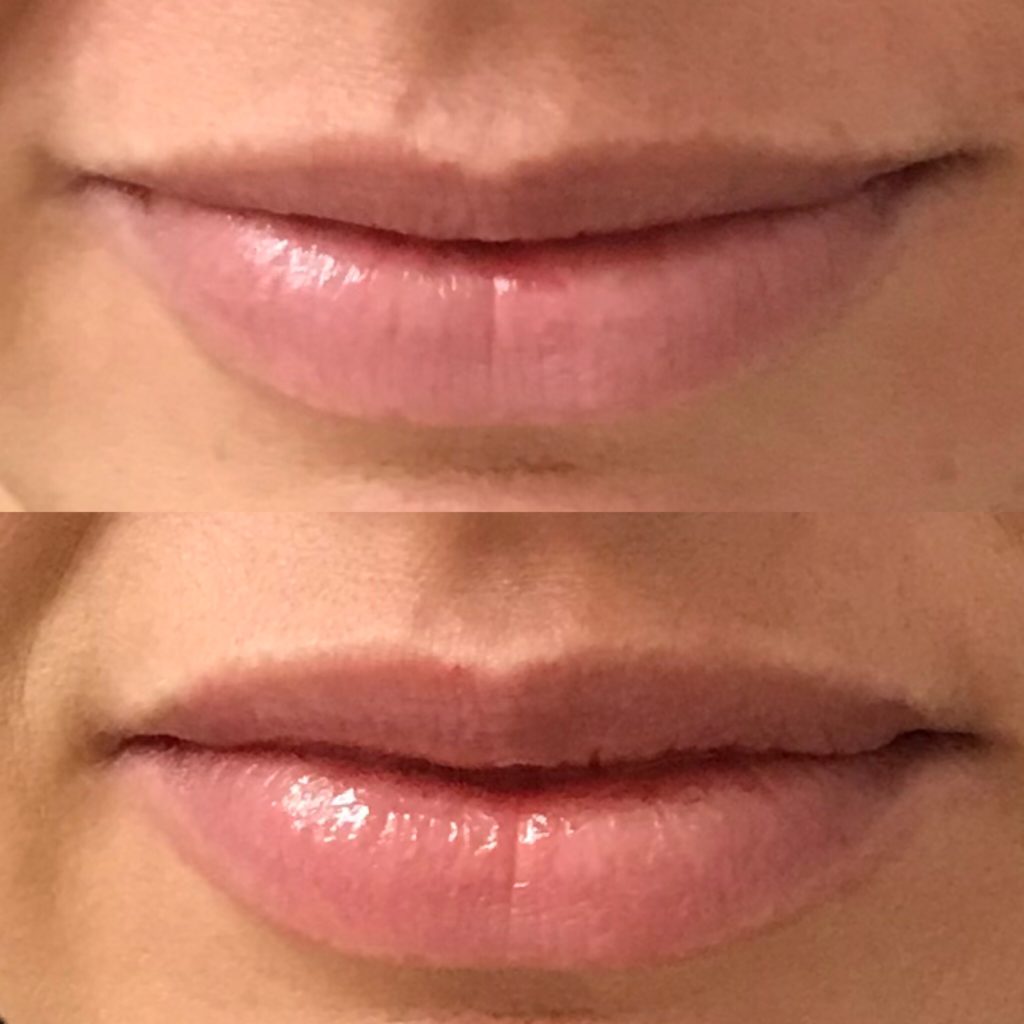 before and after botox lip injections