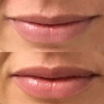 Before and after woman's injection of dermal fillers to enhance lips