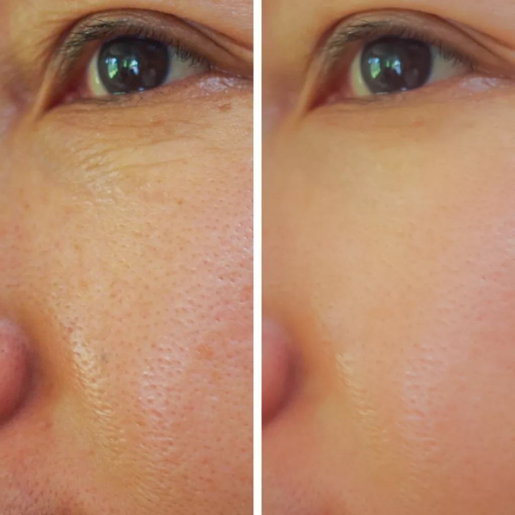 before and after vivace microneedling treatment