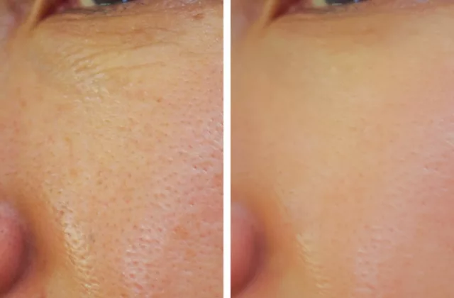 before and after vivace microneedling treatment