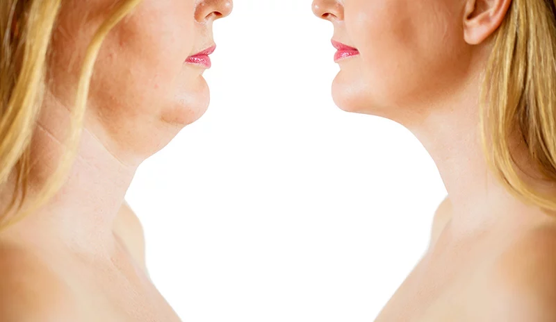 Before and after woman's necklift to address double chin