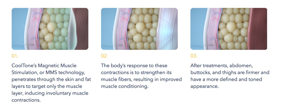 A drawing of what the skin, fat, and muscles look like before, during, and after CoolTone treatment 