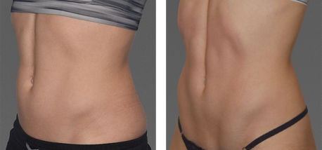 Before and after woman's CoolTone treatment to reduce fat and encourage muscle growth