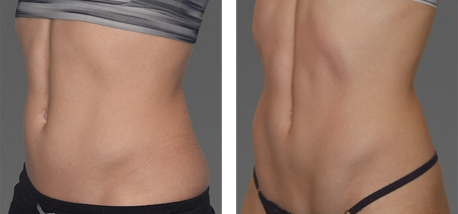 coolsculpting before and after