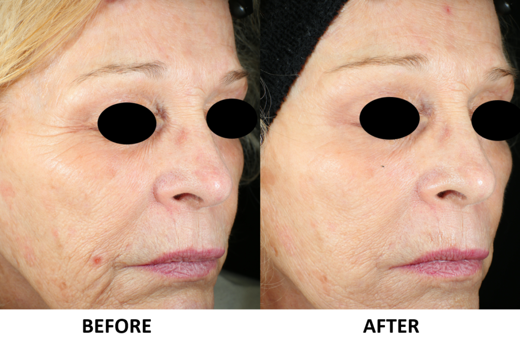 vivace microneedling before and after