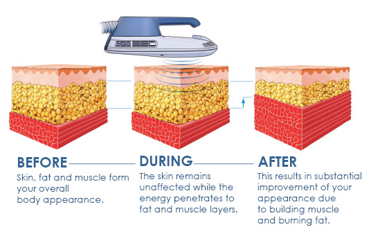 A drawing of what the skin, fat, and muscles look like before, during, and after EmSculpt treatment 