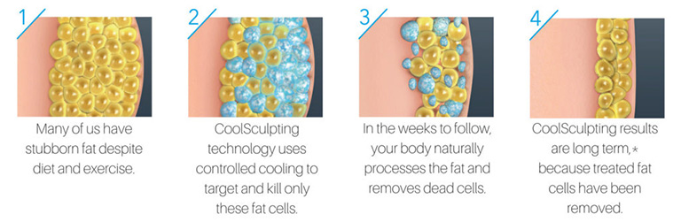 A drawing of what the skin, fat, and muscles look like before, during, and after CoolSculpting treatment 