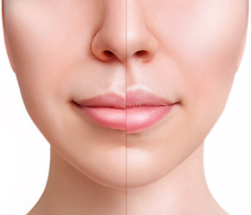 Restylane® Kysse Advanced Lip Filler before and after