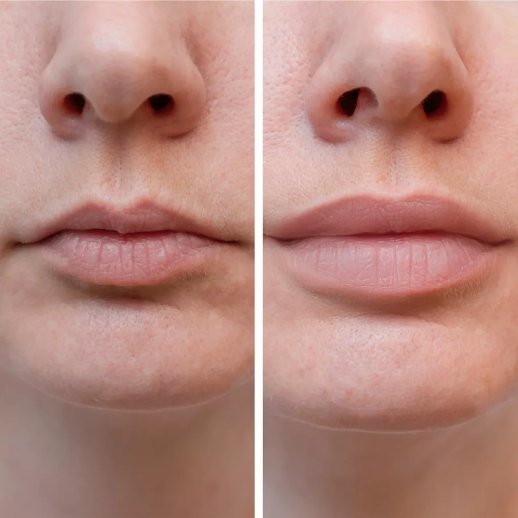 before and after restylane kysse fillers to enhance lip volume and definition