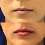 restylane kysse lip filler injections before and after at Artemedica