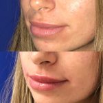 restylane kysse lip filler injections before and after at Artemedica