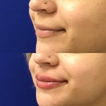 restylane kysse lip filler injections before and after at Artemedica