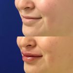 restylane kysse lip filler injections before and after at Artemedica