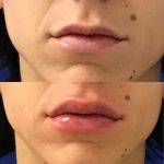 restylane kysse lip filler injections before and after at Artemedica