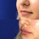 restylane kysse lip filler injections before and after at Artemedica