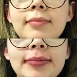 restylane kysse lip filler injections before and after at Artemedica