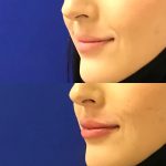 restylane kysse lip filler injections before and after at Artemedica