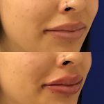 restylane kysse lip filler injections before and after at Artemedica