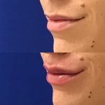 restylane kysse lip filler injections before and after at Artemedica