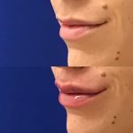 restylane kysse lip filler injections before and after at Artemedica