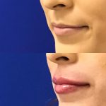 restylane kysse lip filler injections before and after at Artemedica