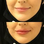 restylane kysse lip filler injections before and after at Artemedica