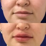 restylane kysse lip filler injections before and after at Artemedica