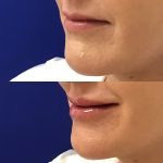 restylane kysse lip filler injections before and after at Artemedica