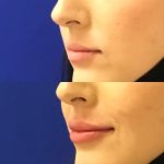 restylane kysse lip filler injections before and after at Artemedica