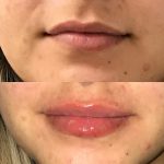 restylane kysse lip filler injections before and after at Artemedica