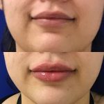 restylane kysse lip filler injections before and after at Artemedica