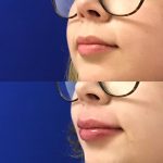 restylane kysse lip filler injections before and after at Artemedica