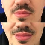 Before and after man's injection of dermal fillers to enhance lips