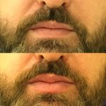 Before and after man's injection of dermal fillers to enhance lips