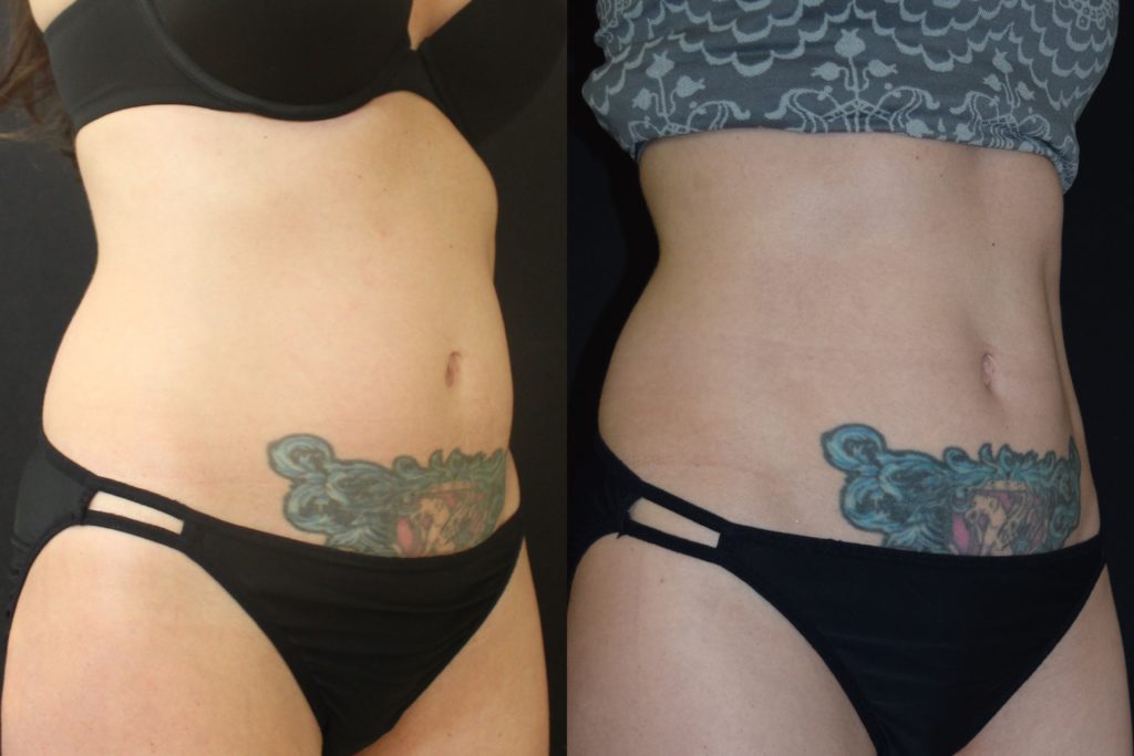 coolsculpting/cooltone before and after