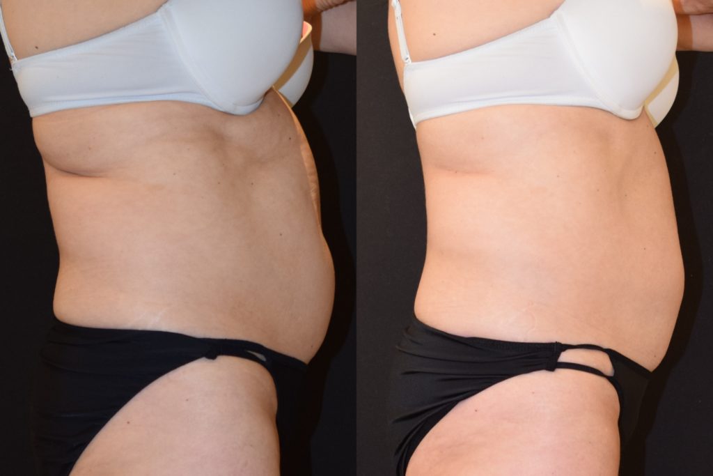 coolsculpting before and after