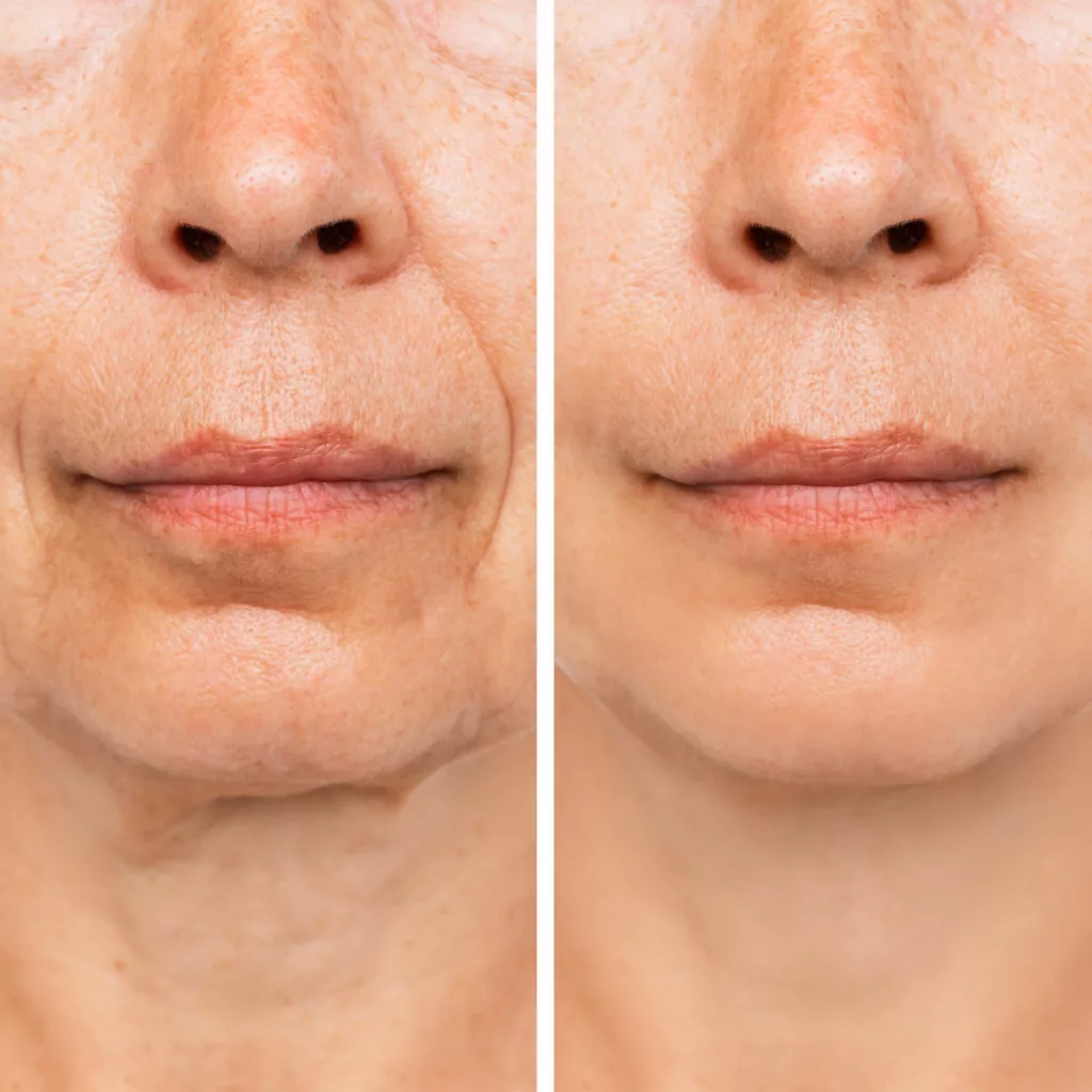 before and after RHA collection fillers for wrinkles and fine lines around the mouth