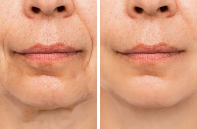 before and after RHA collection fillers for wrinkles and fine lines around the mouth