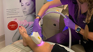 laser hair removal