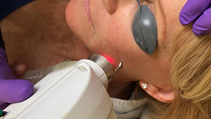 Esthetician using laser resurfacing facial treatment on client's cheek