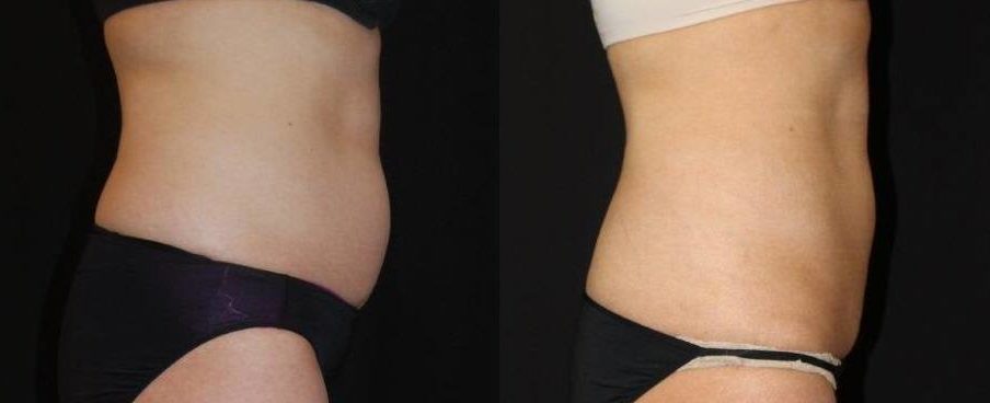 Before and after woman's CoolSculpting treatment to reduce fat and encourage muscle growth