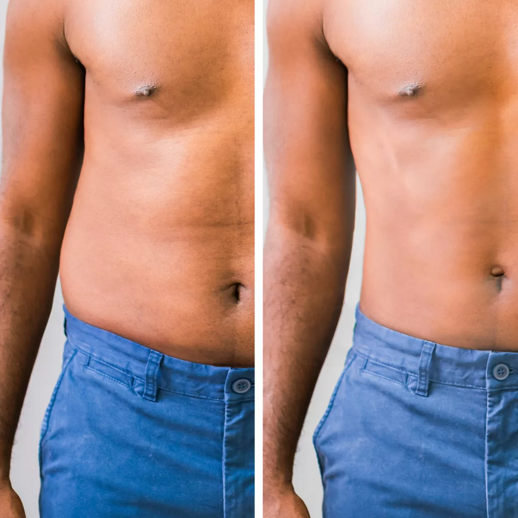 before and after coolsculpting elite for fat reduction