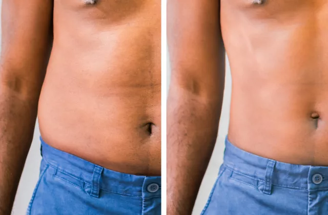 before and after coolsculpting elite for fat reduction